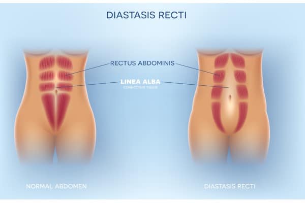 What Non-Surgical Options Are Available for Diastasis Recti Swanage?