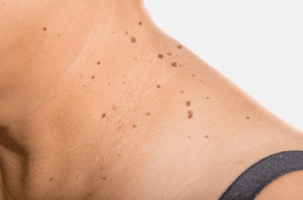 Are you looking for easy skin tag removal Swanage - then contact Spire today!