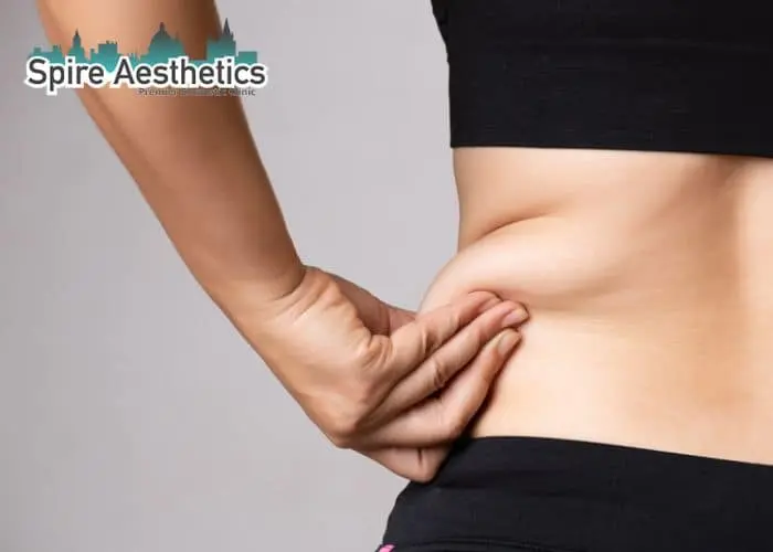 Image of woman pinching fat on their hips Swanage. Fat Freezing treatment