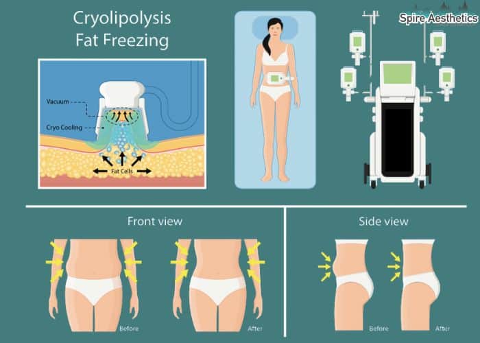 Image of diet and fat freezing combined for best results for Spire Aesthetics Swanage