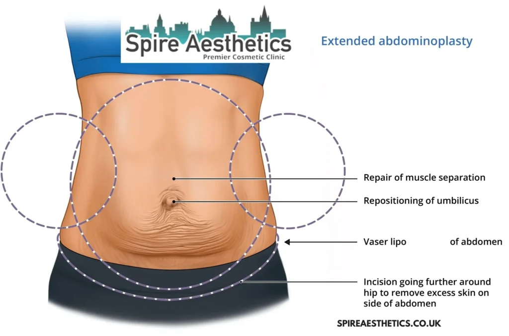 Understanding Loose Skin After Gastric Band Swanage Surgery and HIFU Treatment