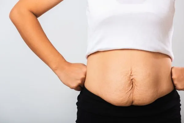 Image of a woman's stomach after weight loss with sagging skin following a gastric band Swanage