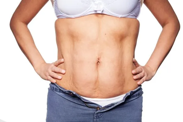 sagging skin on woman's stomach after weight loss injections Swanage