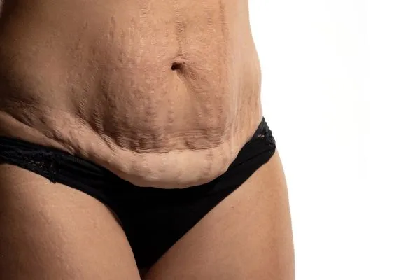 Image of womans stomach after weight loss injections Swanage showing saggy skin