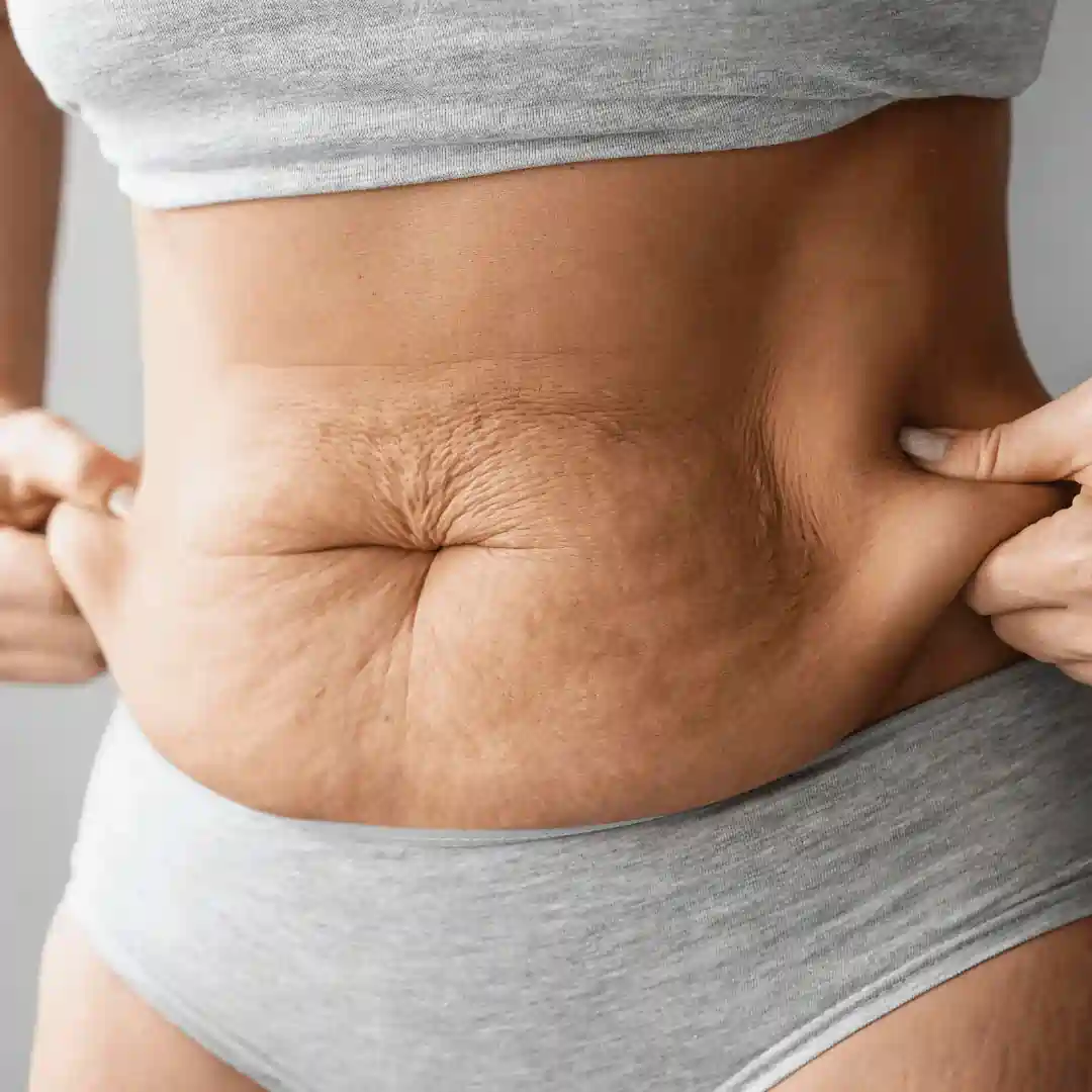 Is It Normal to Have Loose Skin After Pregnancy Swanage?